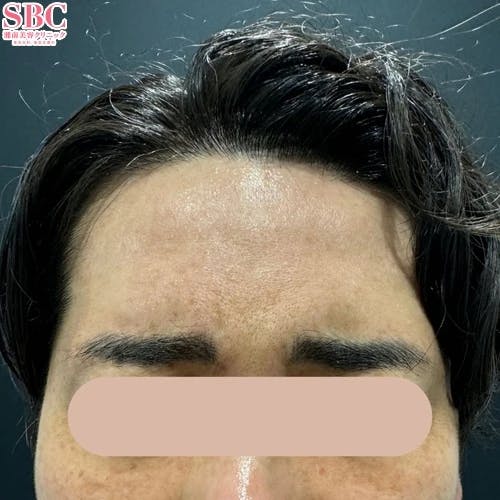 【30代男性・しわ】ボトックス（アラガン）_before