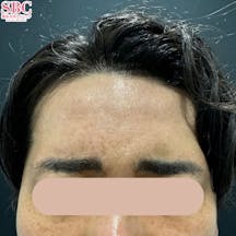 【30代男性・しわ】ボトックス(アラガン)_before