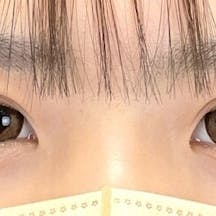 【10代女性・目元】クイックコスメティーク・ダブルNeo_after