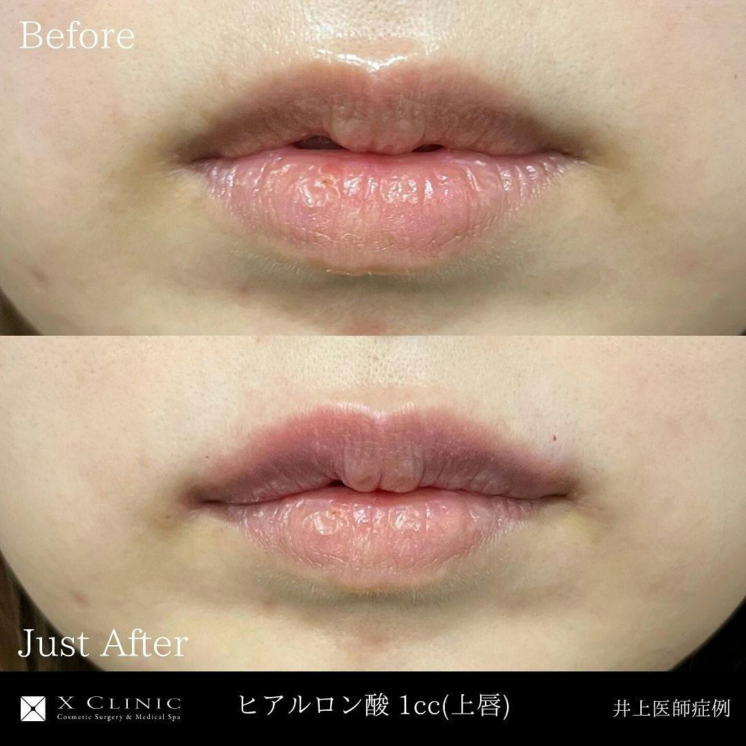 【女性・唇】ヒアルロン酸_before_aftar