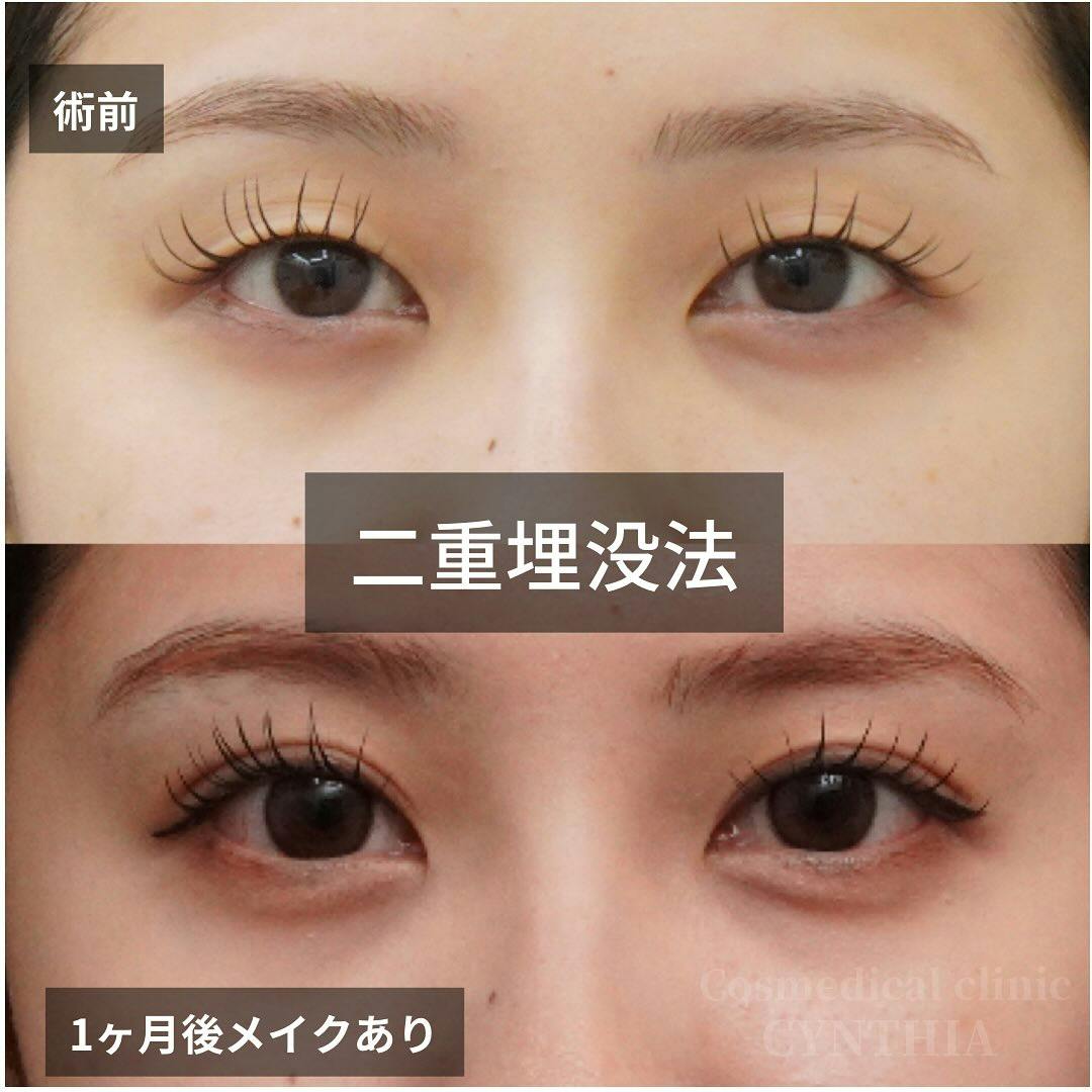 【20代女性・目元】二重埋没法_before_aftar