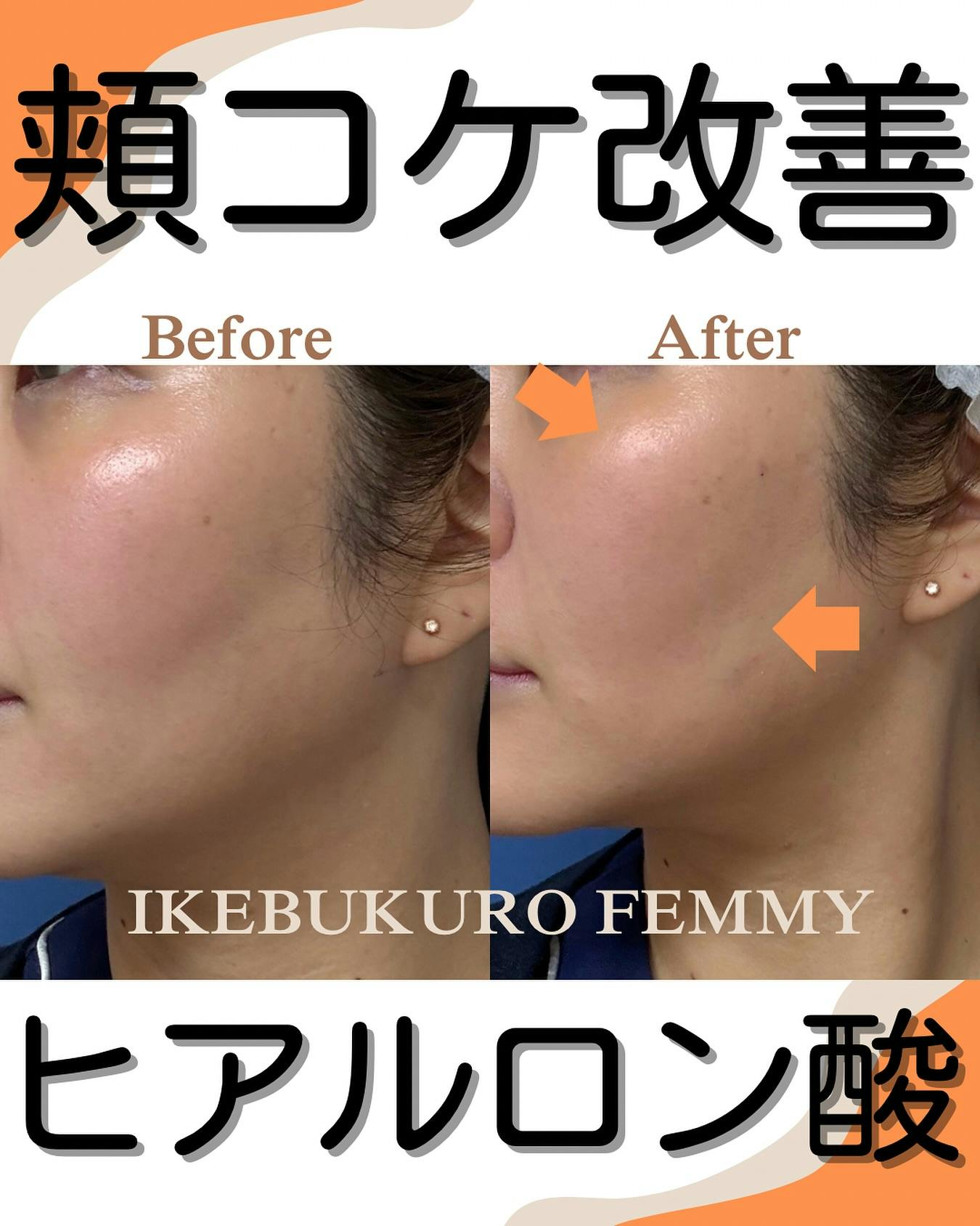 ヒアルロン酸注射・注入・ニューラミス・ジュビダーム(ヒアルロン酸