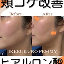 【女性・頬】ビスタシェイプ_before_aftar