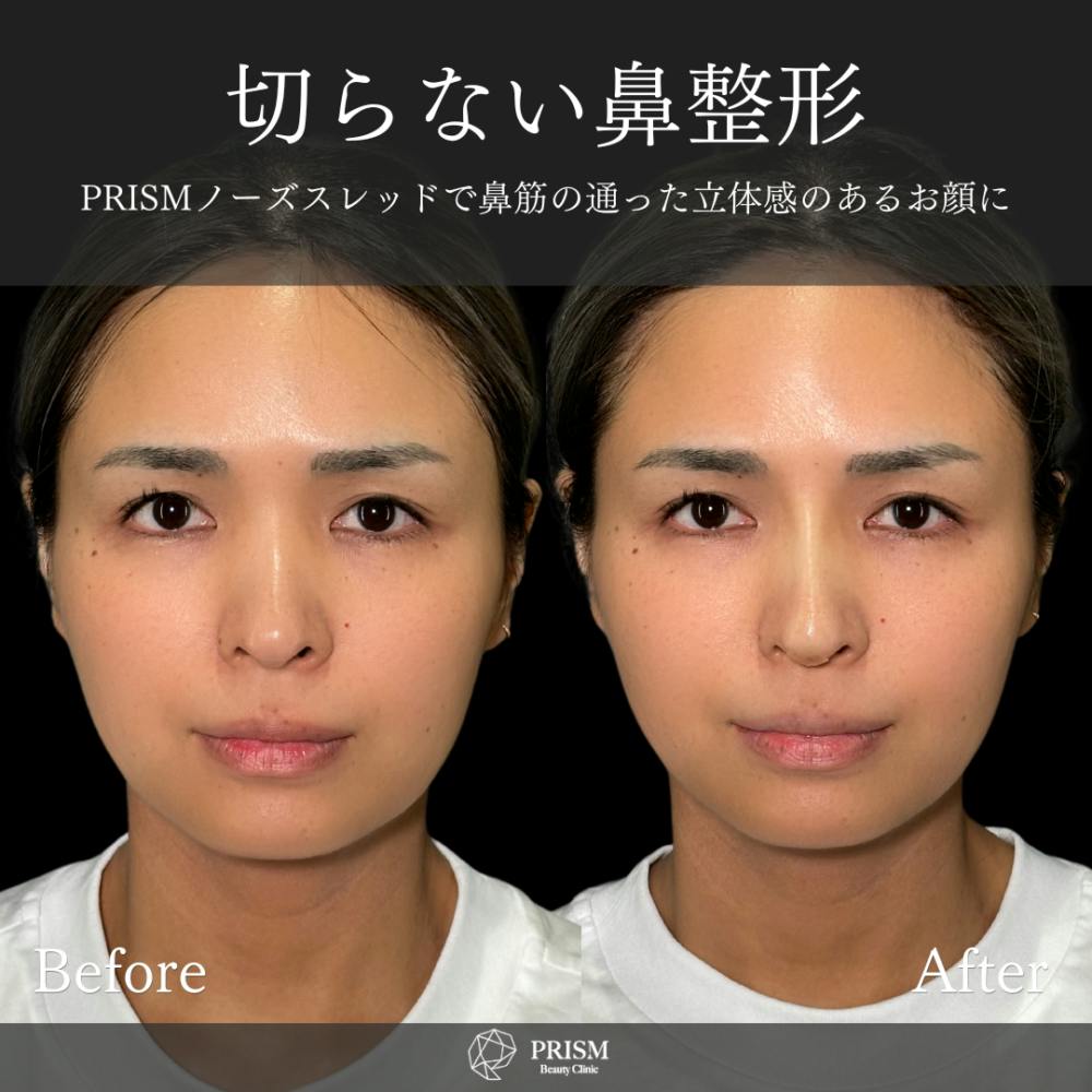 【30代女性・鼻】PRISMノーズスレッド_before_aftar