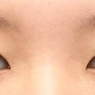 【29歳女性・目元】グランドループ法_before