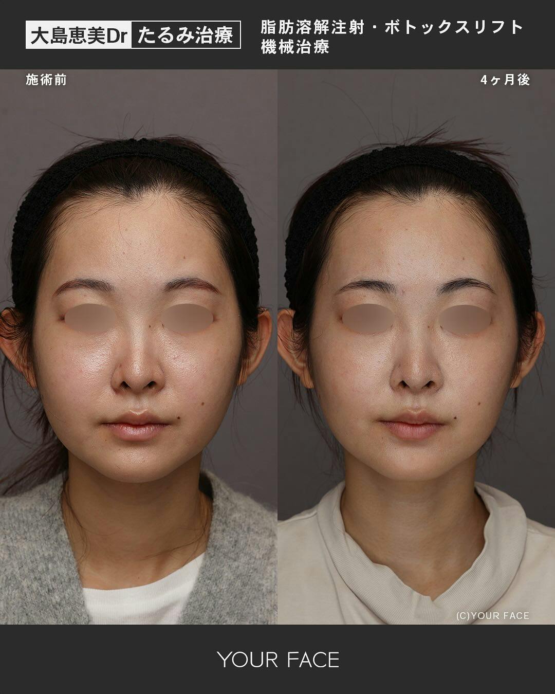 【女性・輪郭】脂肪溶解注射·ボトックスリフト_before_aftar