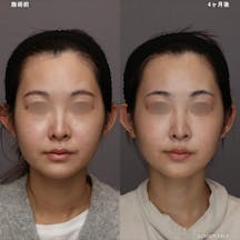 【女性・輪郭】脂肪溶解注射·ボトックスリフト_before_aftar