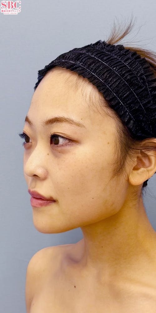 【女性・輪郭】Aquicell（アキーセル）脂肪吸引、根こそぎVASER脂肪吸引_aftar