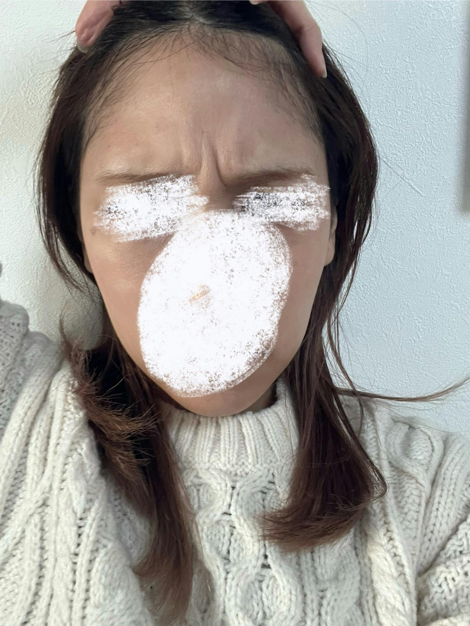 モーブビューティークリニック札幌大通(Mauve Beauty Clinic 札幌大通)でおでこ(額)ボトックス注射を受けたelleriさんの写真