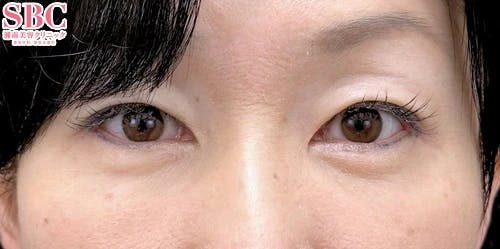 【50代女性・目元】目の下の切らないクマ・たるみ（ふくらみ）取り、ナチュラル脂肪注射ナノリッチ、ナチュラル脂肪注射コンデンスリッチ_after