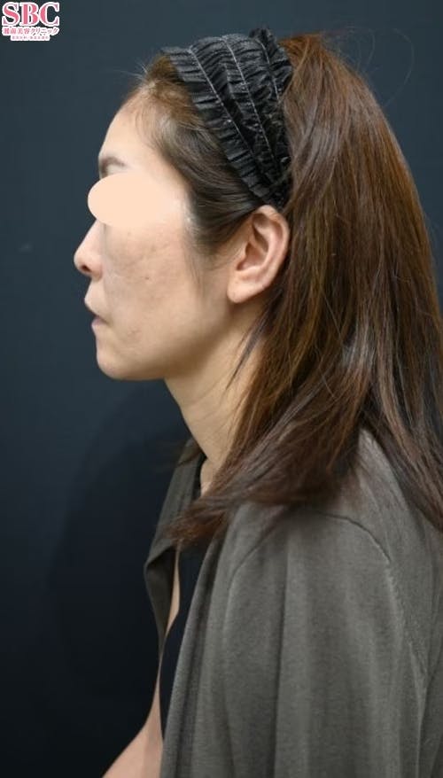 【40代女性・輪郭】ヒアルロン酸、ヒアルロン酸ジュビダームビスタ バイクロスシリーズ_after