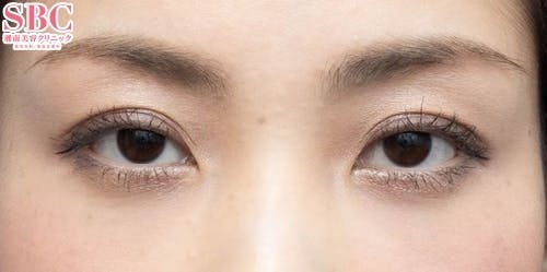 【30代女性・目元】目の下の切らないクマ・たるみ（ふくらみ）取り、ナチュラル脂肪注射コンデンスリッチ、ナチュラル脂肪注射ナノリッチ_after