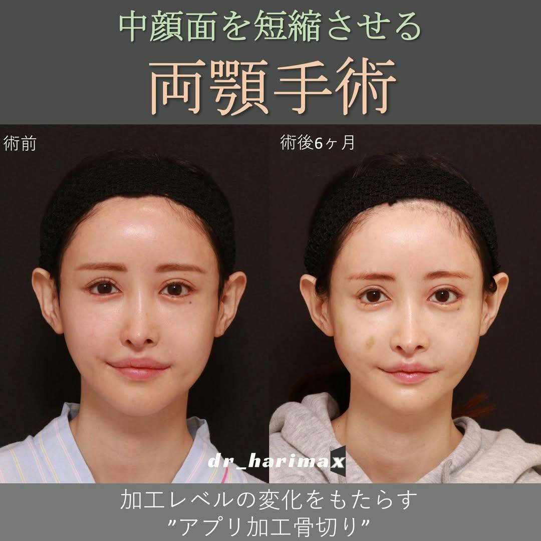 ヒアルロン酸注射・注入・ニューラミス・ジュビダーム(ヒアルロン酸