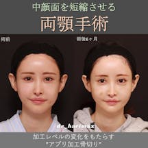 【女性・顎】上下顎骨切り術_before_aftar