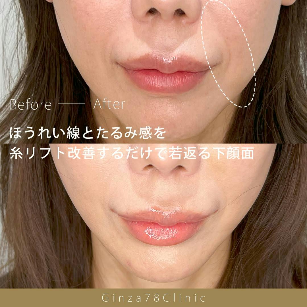 スレッドリフトのセオリー【裁断済み】 71ViYOihO9L.jpg