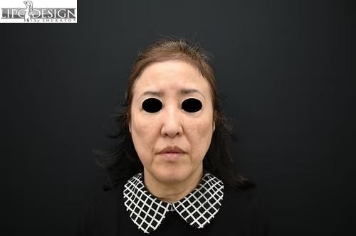 【64歳女性・口元】SBCプレミアムPRP皮膚再生療法_before