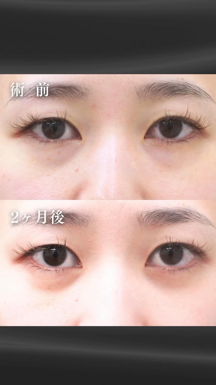 【女性・目元】経結膜脱脂術・眼窩脂肪注入_before_aftar