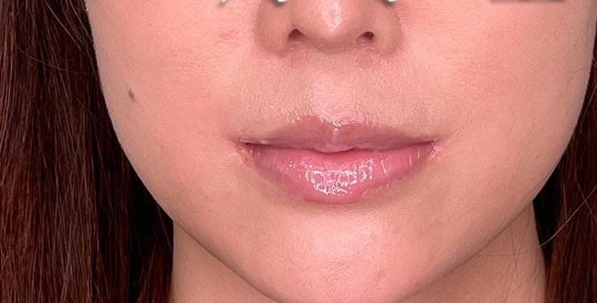 横浜TAクリニックで口角挙上・リフト（マイクロ切開法・内側法/口内法）：口角挙上（内側法）を受けたわっちさんの写真