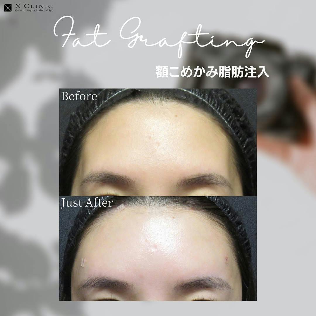【女性・額】額こめかみ脂肪注入_before_aftar