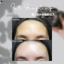 【女性・額】額こめかみ脂肪注入_before_aftar