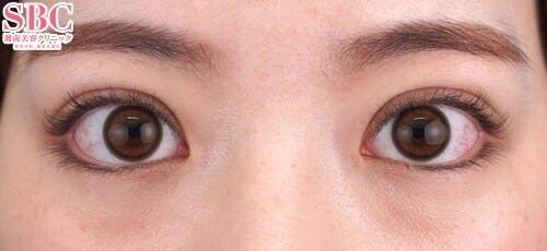 【20代女性・目元】クイックコスメティーク・トリプルNeo_1month