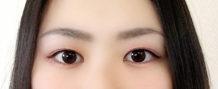 品川美容外科渋谷院(※品川スキンクリニック提携)で二重整形・二重埋没を受けたマリアさんの写真