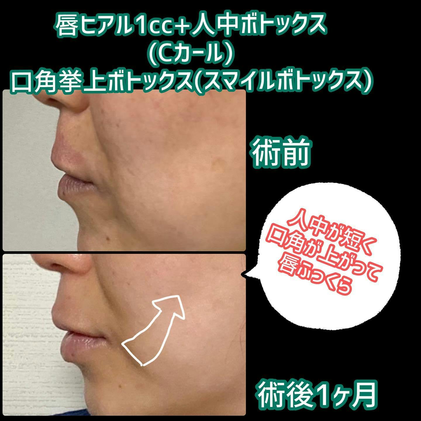 【女性・口元】唇ヒアル＋人中ボトックス (Cカール)＋口角挙上ボトックス(スマイルボトックス)_before_aftar