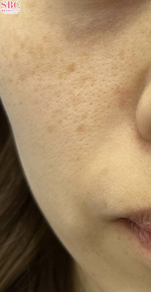 【女性・ほうれい線】シークレットリフト・VOV(ボブ)リフト・ヒアルロン酸ジュビダームビスタ バイクロスシリーズ_before