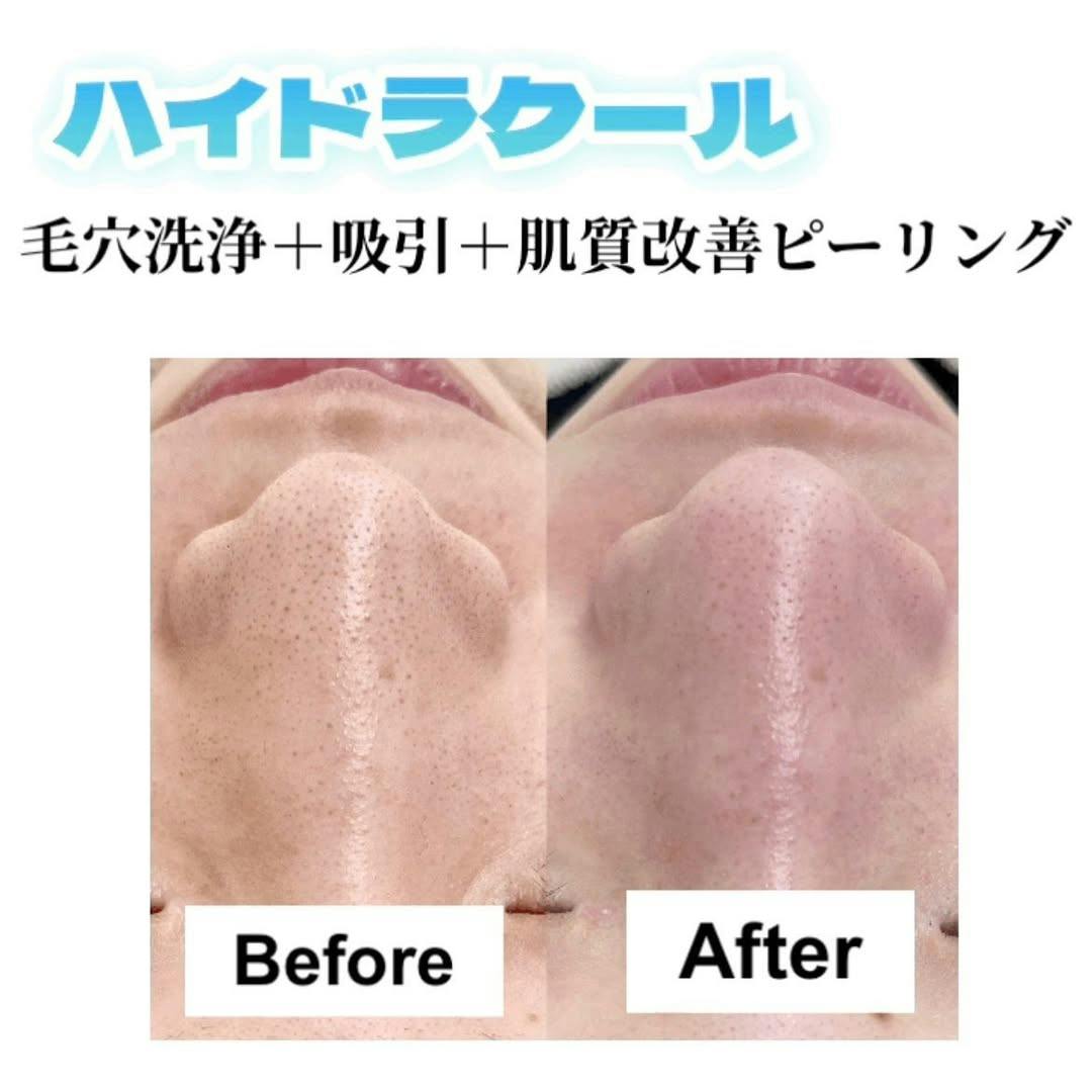 【女性・毛穴】ハイドラクール_before_aftar