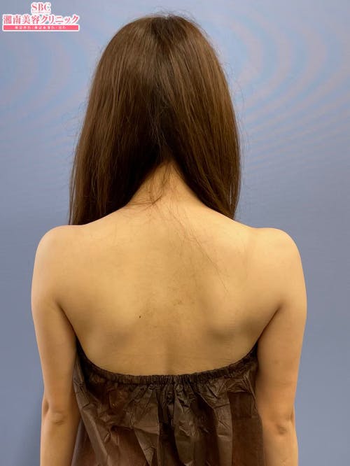 【女性・二の腕】美ボディ脂肪吸引_before