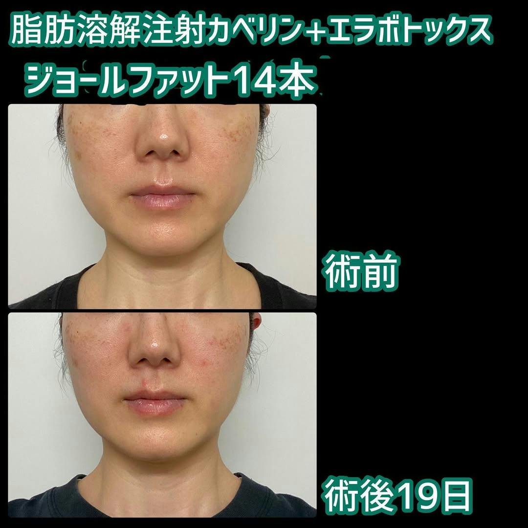 【女性・小顔】脂肪溶解注射カベリン、エラボトックス_before_aftar