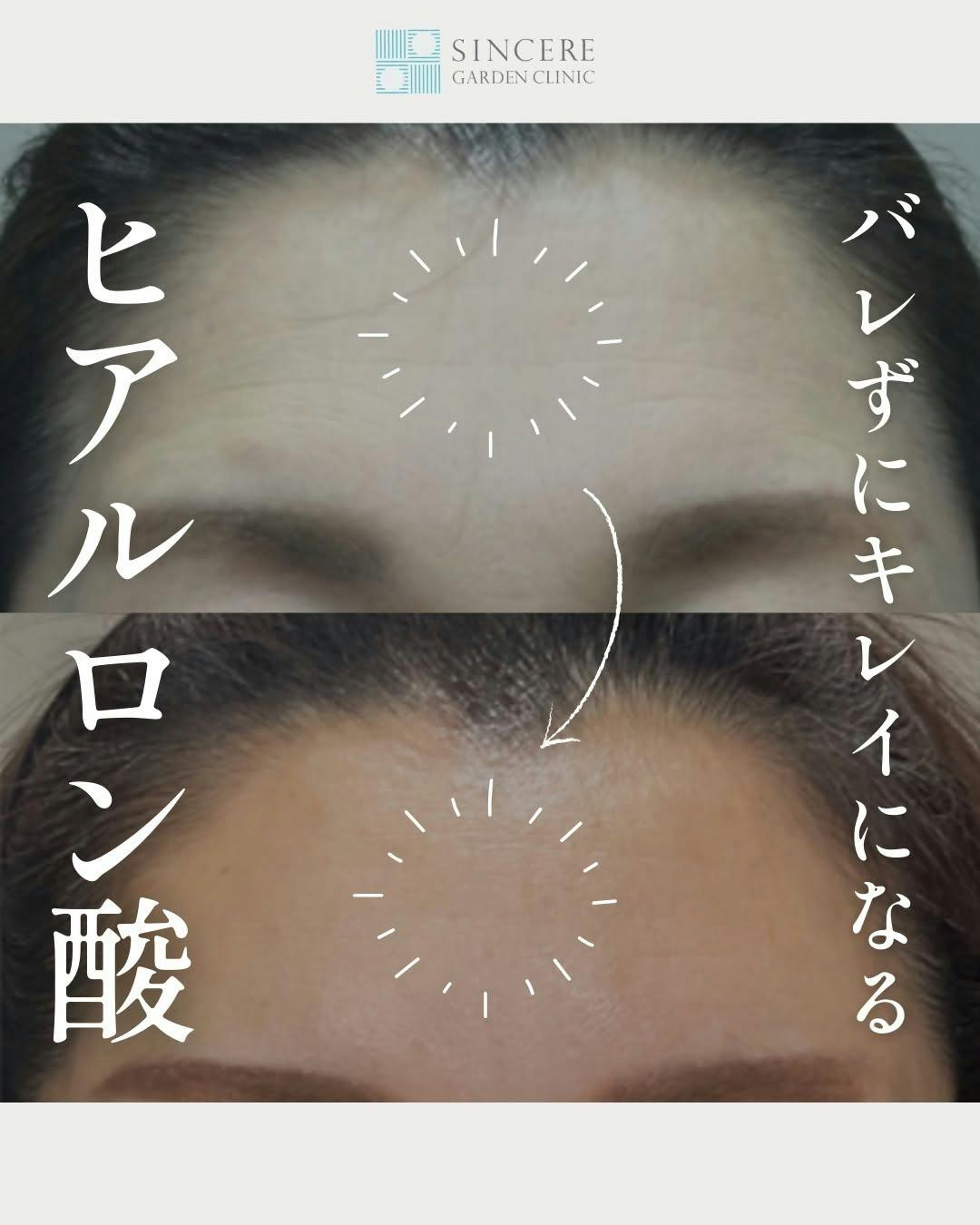 【女性・額】ヒアルロン酸_before_aftar