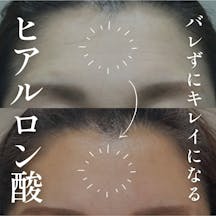 【女性・額】ヒアルロン酸_before_aftar