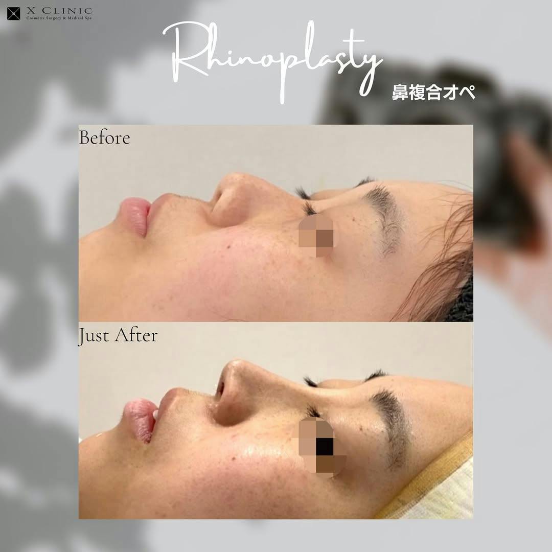 【女性・鼻】鼻複合オペ_before_aftar