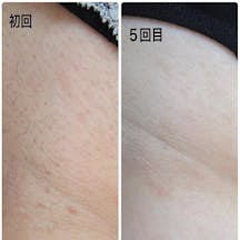 【脇】脱毛施術_before_aftar