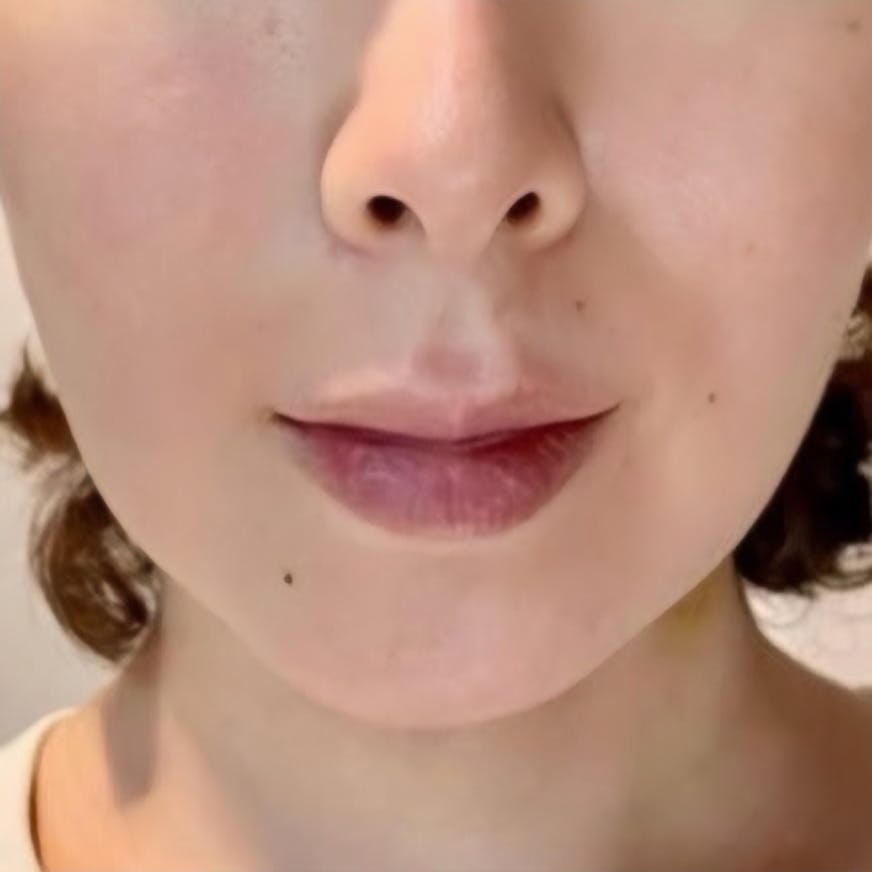 ルラ美容クリニック 渋谷本院でエラボトックスを受けたさあやさんの写真