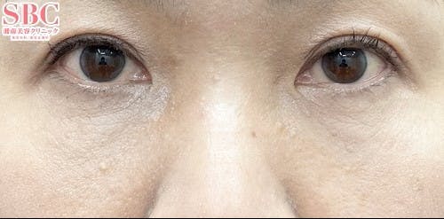 【女性・目元】目の下の切らないクマ・たるみ（ふくらみ）取り、ナチュラル脂肪注射コンデンスリッチ、ナチュラル脂肪注射ナノリッチ_after