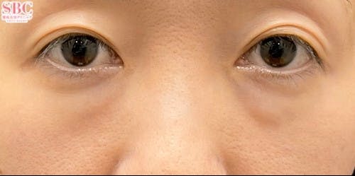 【40代女性・クマ】裏ハムラ法 ナチュラル脂肪注射ナノリッチ_before