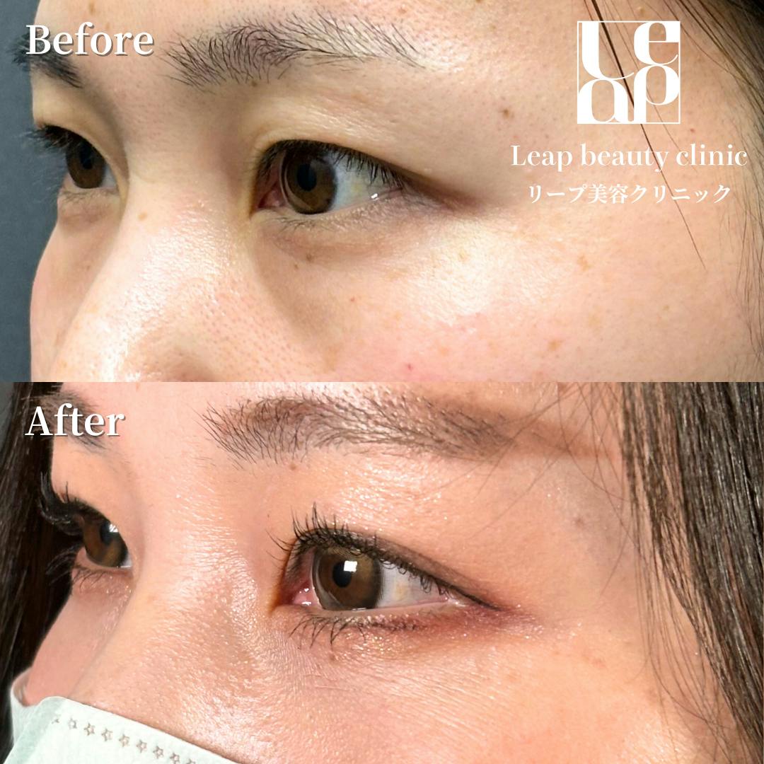 【30代女性・目元】二重埋没法・上まぶたの脂肪取り・切らない目の下のたるみ取り_before_aftar