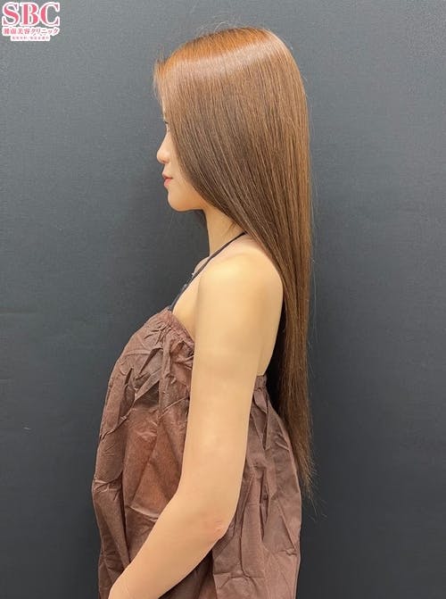 【女性・二の腕】Aquicell（アキーセル）脂肪吸引_aftar