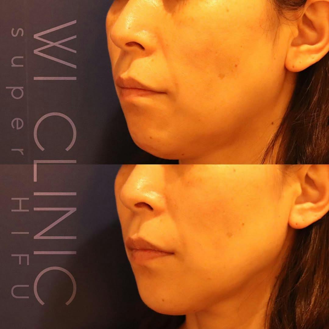 【40代女性・小顔】スーパーハイフ_before_aftar