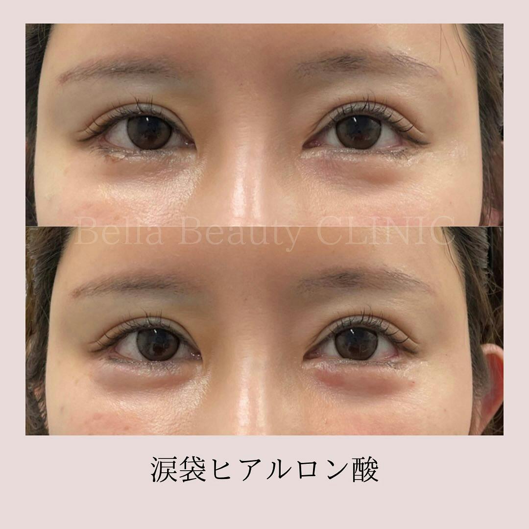 【女性・涙袋】ヒアルロン酸ライト0.3cc_before_aftar