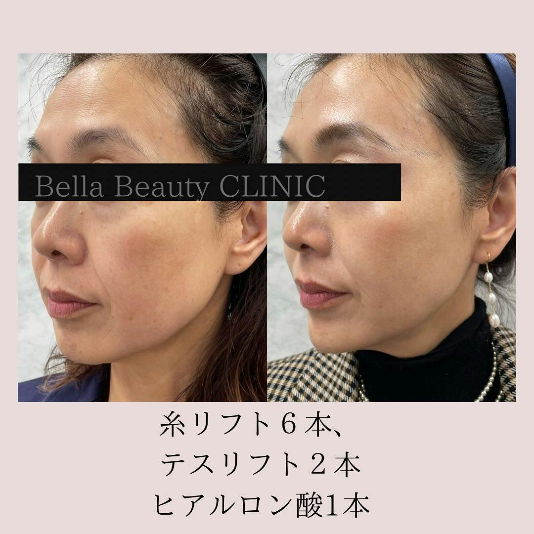 【女性・たるみ】糸リフト（フェイスライン）_before_aftar