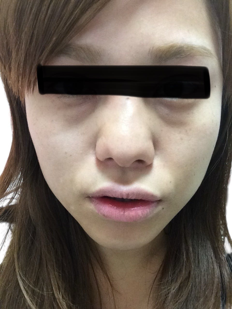 湘南美容クリニック 札幌大通院で目の下のクマ・たるみ取り・・脂肪注入(こめかみ)・脂肪注入(顔)・脂肪注入(ゴルゴ線)・目の下のクマ脂肪注入を受けたりりさんの写真