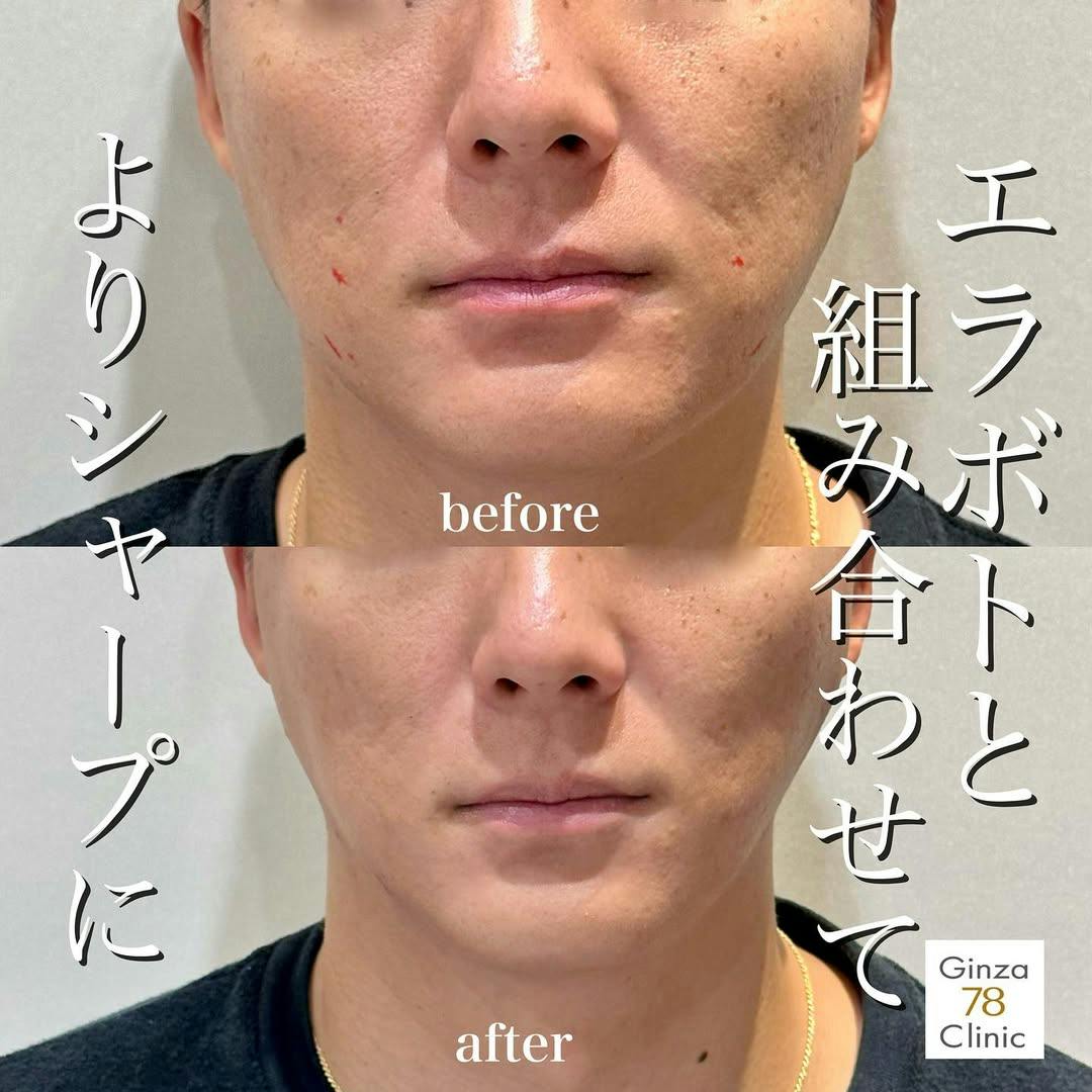 【男性・輪郭】スタンダードPDO_before_aftar