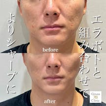 【男性・輪郭】スタンダードPDO_before_aftar