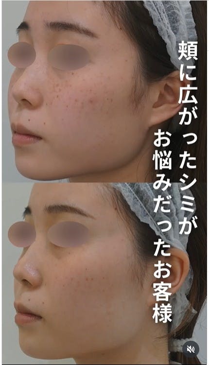 【女性・シミ】ピコスポット_before_aftar