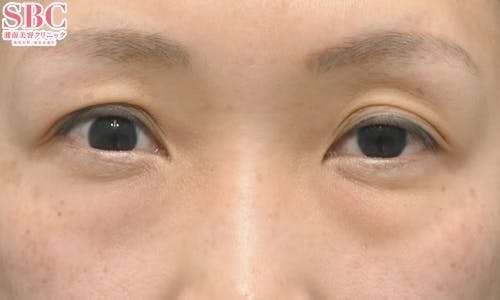 【30代女性・たるみ】目の下の切らないクマ・たるみ（ふくらみ）取り ナチュラル脂肪注射コンデンスリッチ ナチュラル脂肪注射ナノリッチ_before