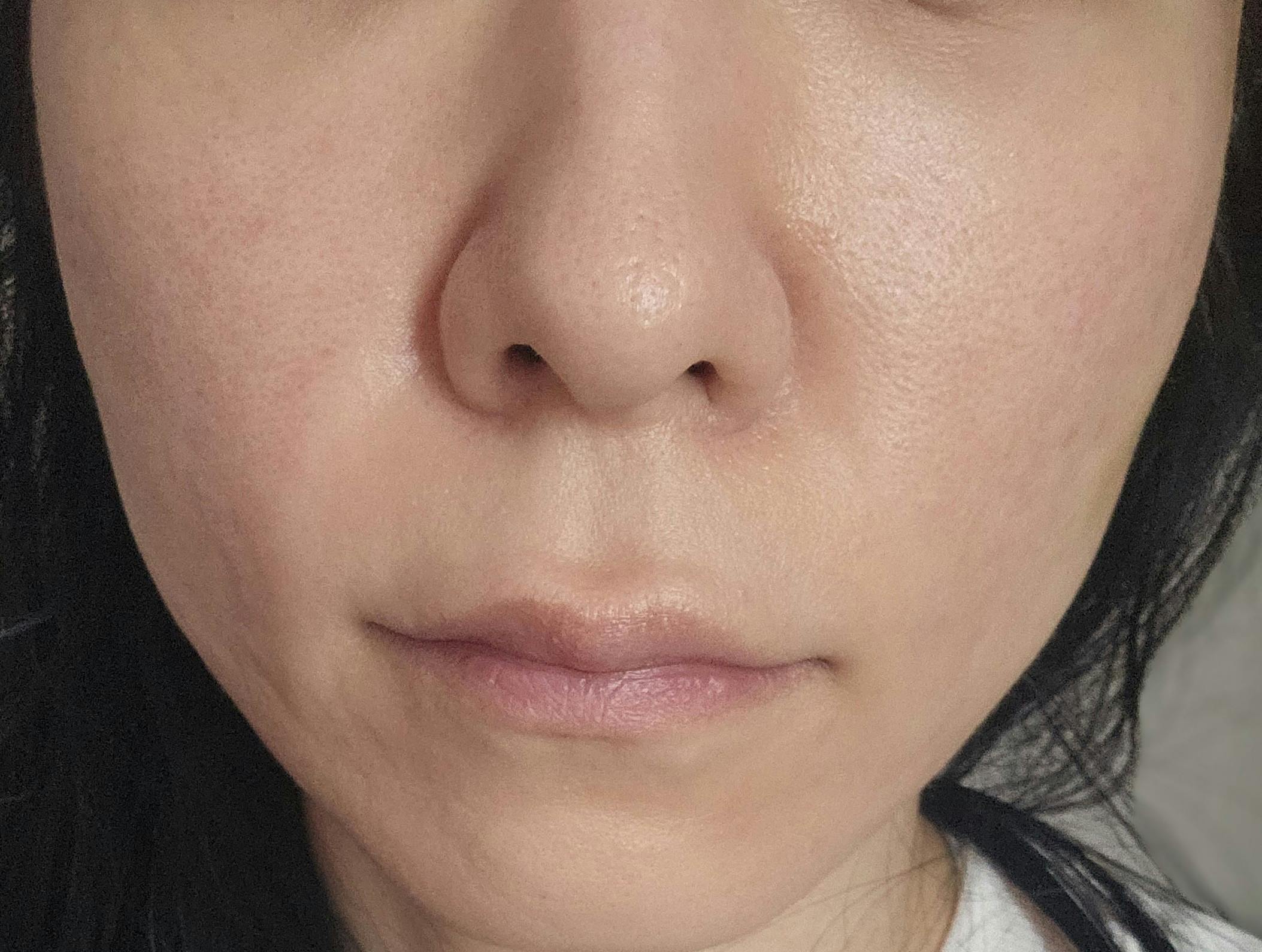 湘南美容クリニック 仙台院でプロファイロを受けたYSさんの写真