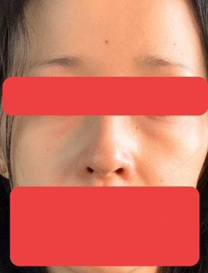 e-clinic(eクリニック) 東京院でクマ取り・目の下のたるみ取り：非切開による脂肪除去を受けたみぽりんさんの写真